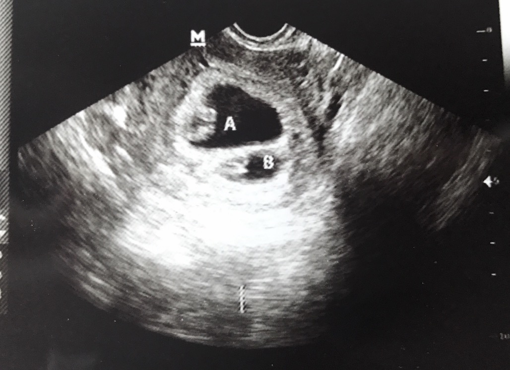 twin ultrasound