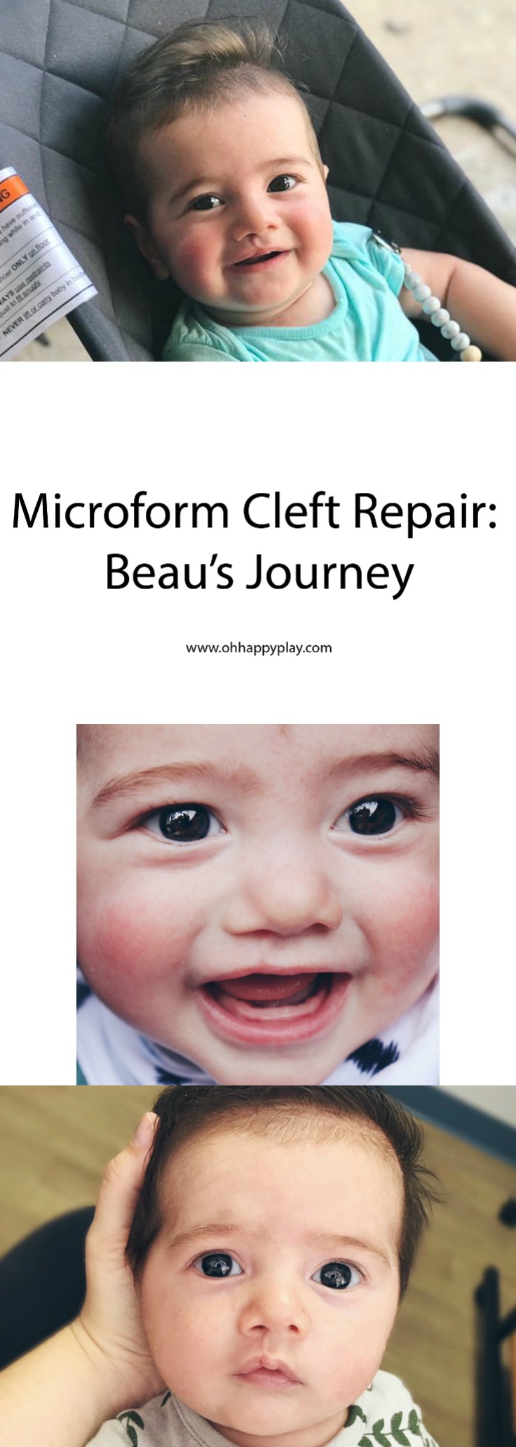 Microform Cleft Repair: Oh Happy Play a Florida Motherhood blogger shares a look at her son Beau's journey with a microform cleft lip. 